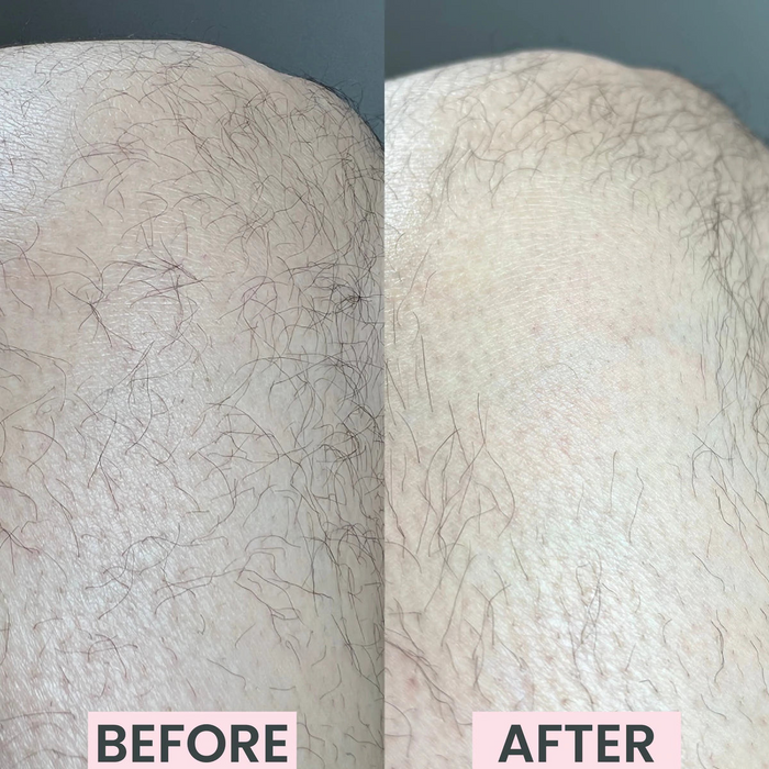 Silkly - Kristall Hårborttagare